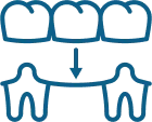Dental Bridges